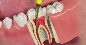 Root Canal - Emergency Dental Treatment