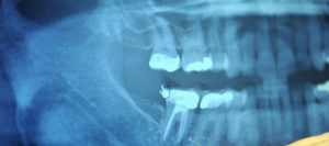 Root Canal x-rays