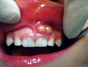 tooth abscess