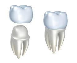 Dental Crown Image