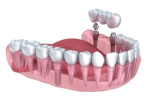 Implant dentistry